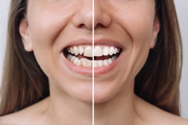Comparison of before and after orthodontic treatment